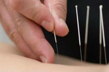 Secretaria de Saúde oferece tratamentos com acupuntura e auriculoterapia